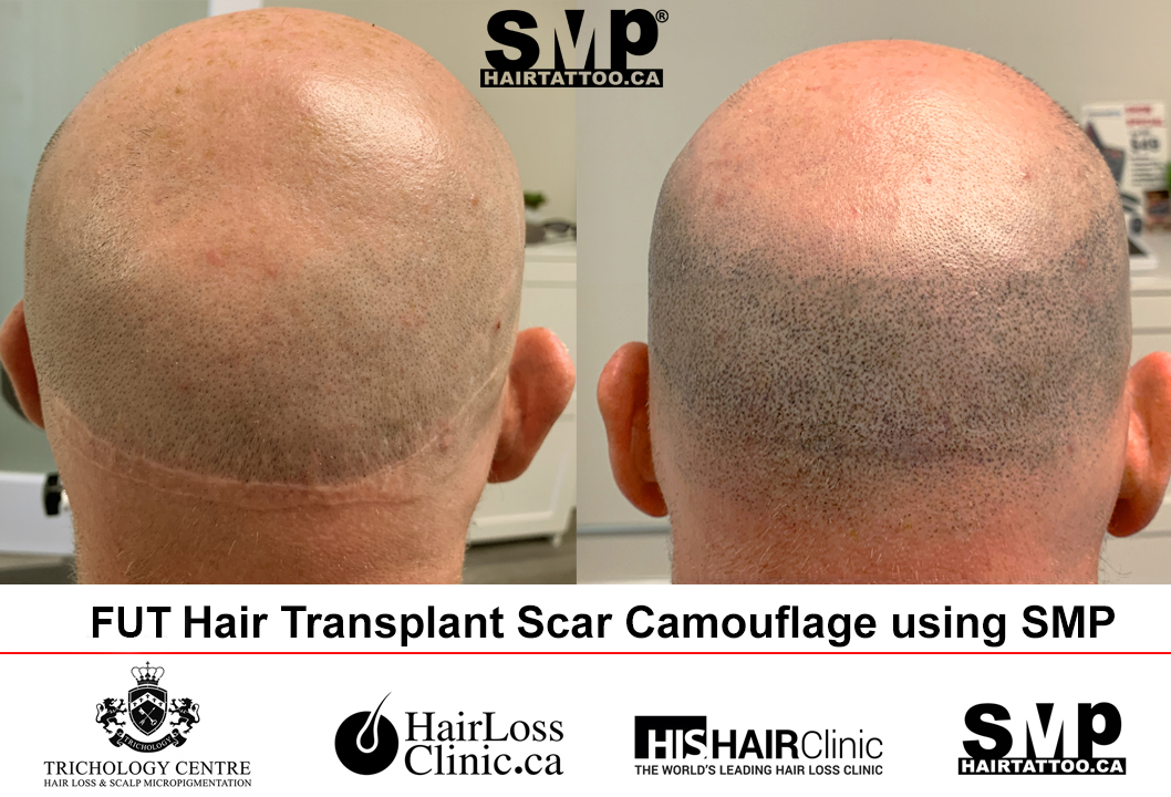SMP scar camouflage