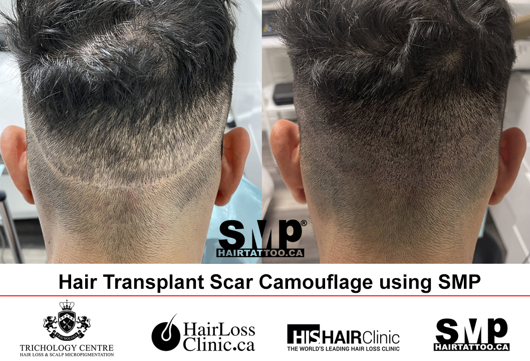 SMP scar camouflage