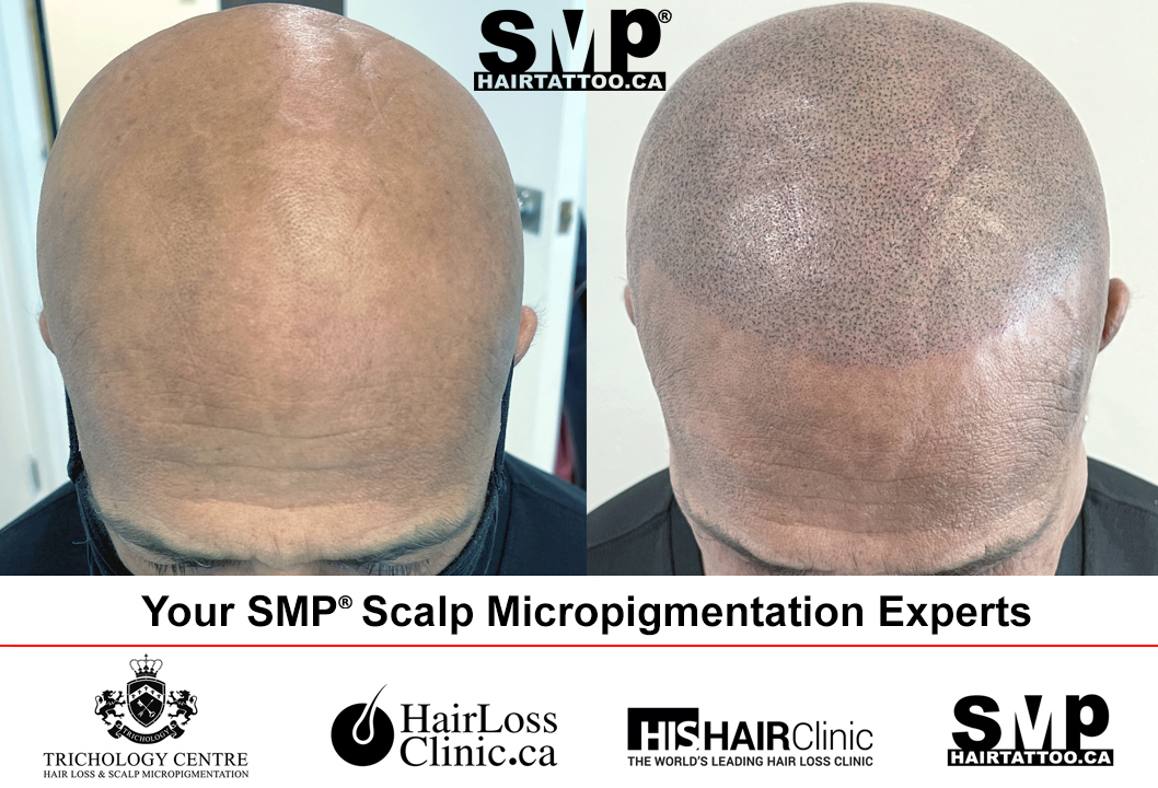 SMP before and after