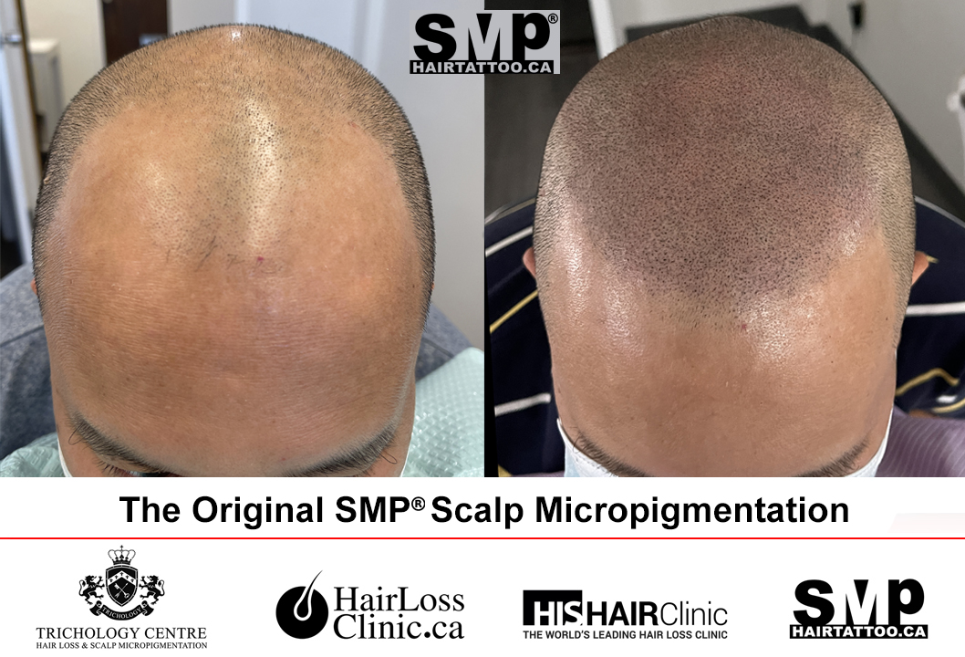 SMP before and after
