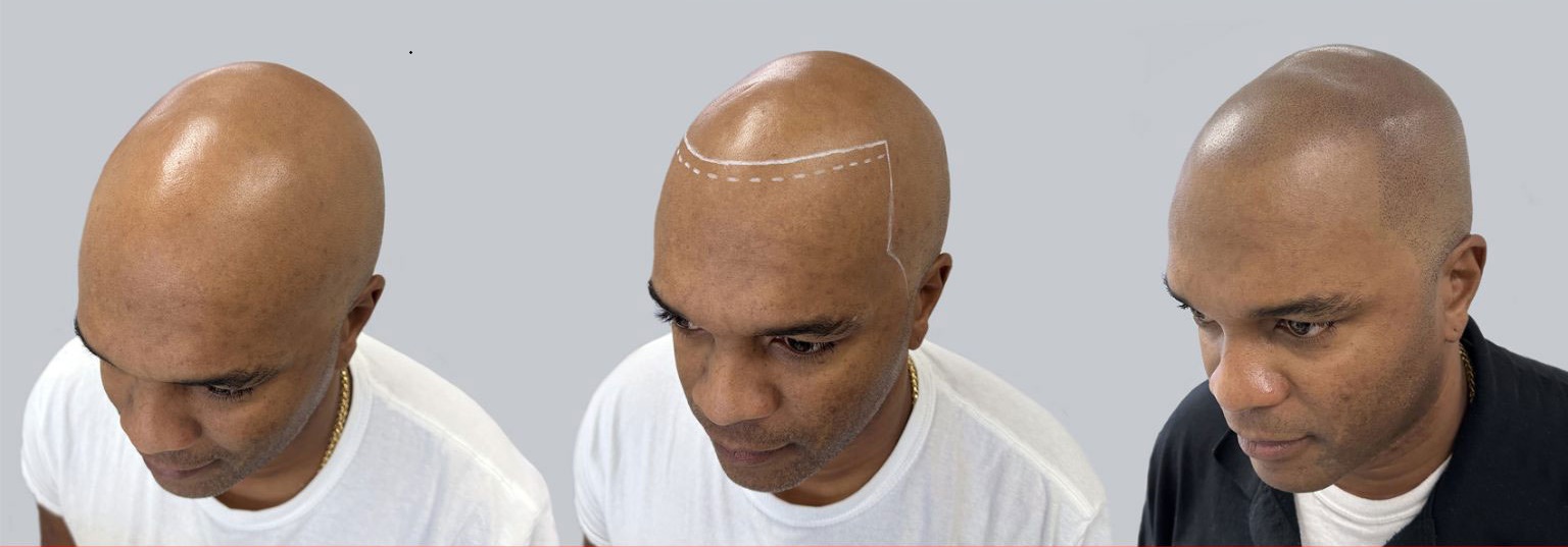 SMP 3-stage transformation: before, hairline design, and final result